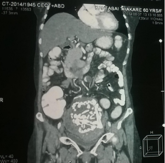 CT scan showing the skeleton of the foetus