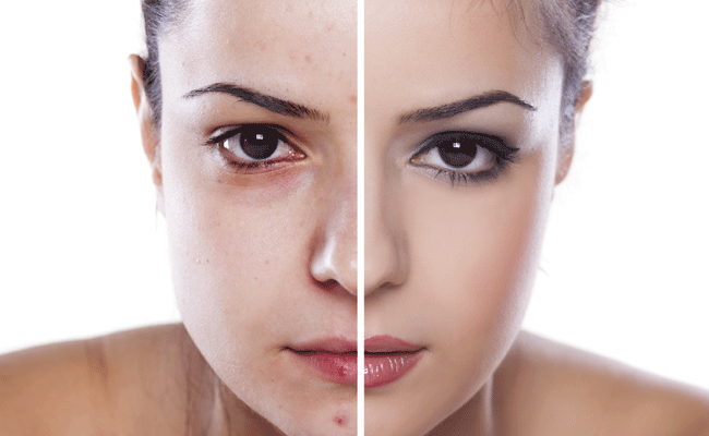 Sudocrem Works Perfect For Spots.. Gets Rid Practically ... 14 Natural Ways To Get Rid of Acne Forever! - Indiatimes.com