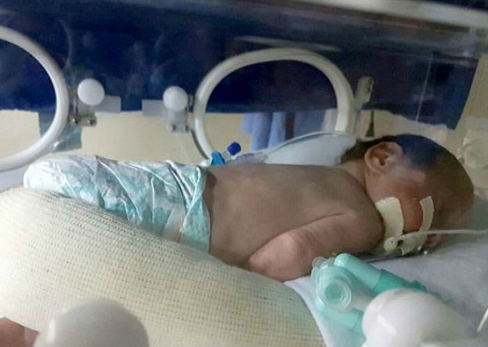 brain dead pregnant woman gives birth to twins brain dead pregnant woman gives birth to twins