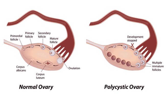 PCOS (POLYCYSTIC OVARY SYNDROME) CURE
