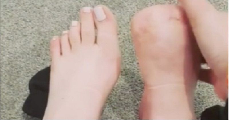 Beauty Treatment Gone Wrong Woman Loses Toes After A