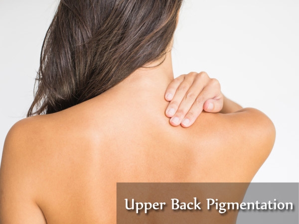 Pigmentation of the Upper Back: Causes and Treatments | Healthy Living