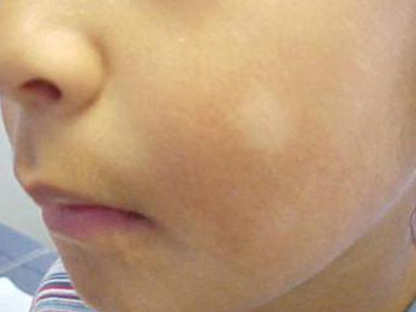 reasons-for-white-skin-patches-in-children-healthy-living